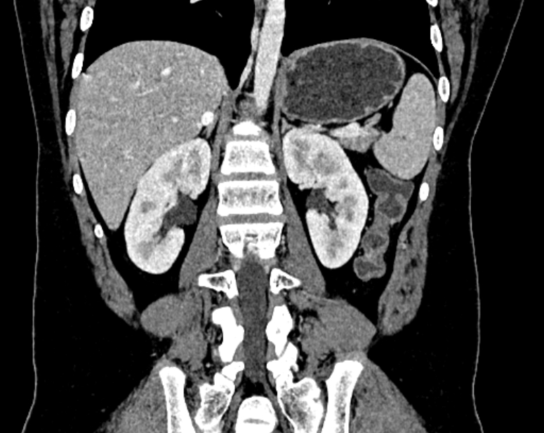 Accessory right inferior hepatic vein (Radiopaedia 75207-86305 Coronal C+ portal venous phase 47).jpg