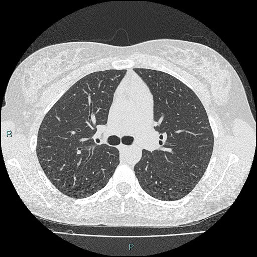 Accidental foreign body aspiration (seamstress needle) (Radiopaedia 77740-89983 Axial lung window 25).jpg