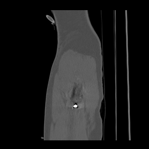 Acetabular and ilial fractures (Radiopaedia 59084-66378 Sagittal bone window 99).jpg