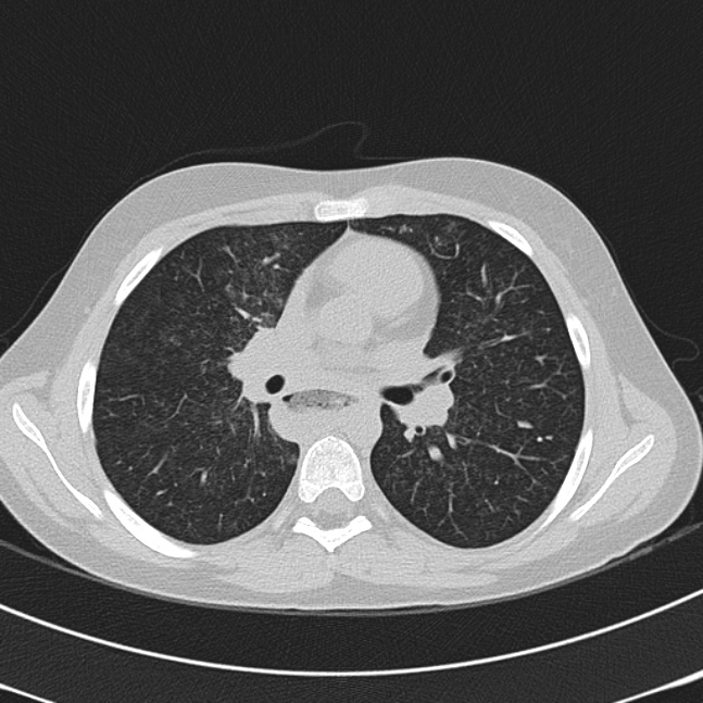 Achalasia (Radiopaedia 14946-14878 Axial lung window 34).jpg