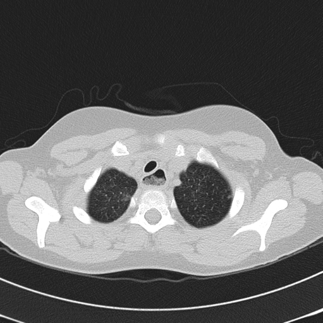 Achalasia (Radiopaedia 14946-14878 Axial lung window 6).jpg