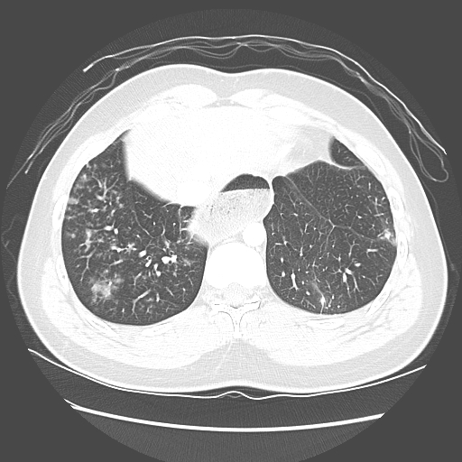 Achalasia (Radiopaedia 52507-58417 Axial lung window 51).jpg