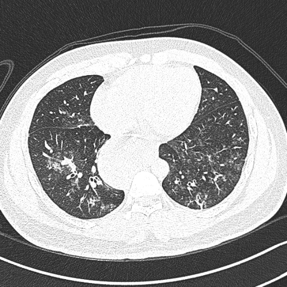 File:Achalasia with aspiration (Radiopaedia 55413-61845 Axial lung window 52).jpg