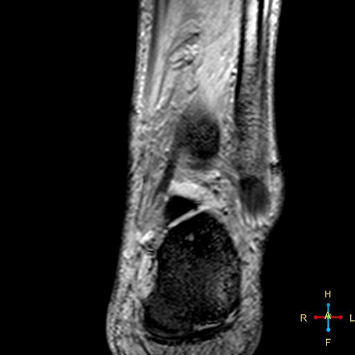 File:Achilles tendon complete tear (Radiopaedia 22834-22854 T2 fat sat 11).jpg