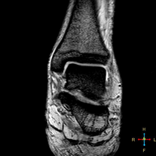 File:Achilles tendon complete tear (Radiopaedia 22834-22854 T2 fat sat 6).jpg