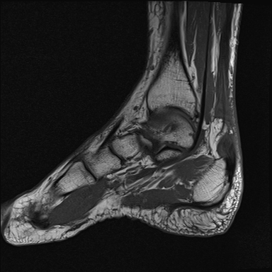 File:Achilles tendon tear (Radiopaedia 77615-89819 Sagittal T1 7).jpg