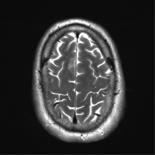 File:Achondroplasia (Radiopaedia 65109-74105 Axial T2 34).png