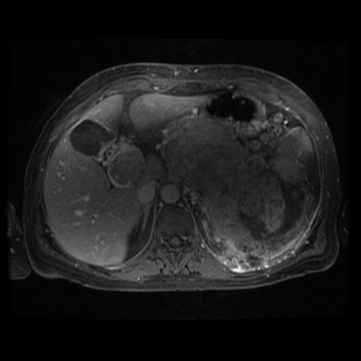 Acinar cell carcinoma of the pancreas (Radiopaedia 75442-86668 Axial T1 C+ fat sat 83).jpg