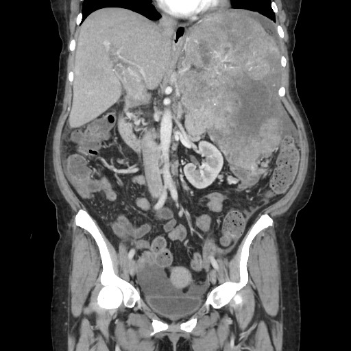 Acinar cell carcinoma of the pancreas (Radiopaedia 75442-86669 Coronal C+ portal venous phase 63).jpg