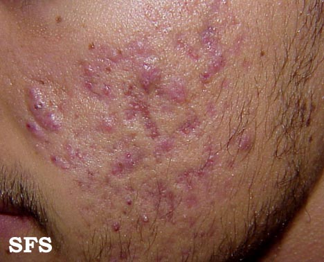 File:Acne (Dermatology Atlas 2).jpg