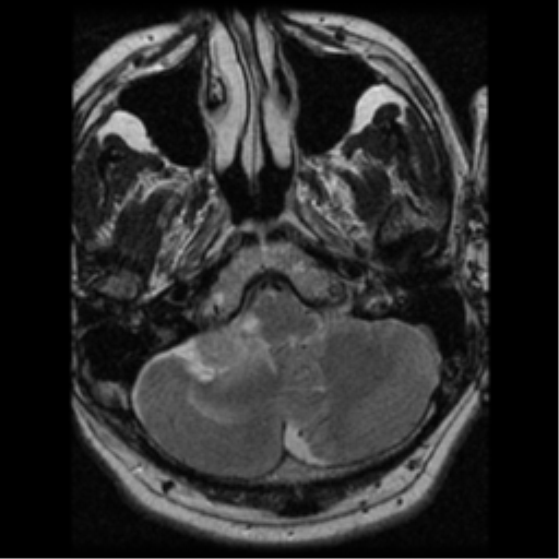 File:Acoustic schwannoma (Radiopaedia 39170-41387 Axial T2 5).png