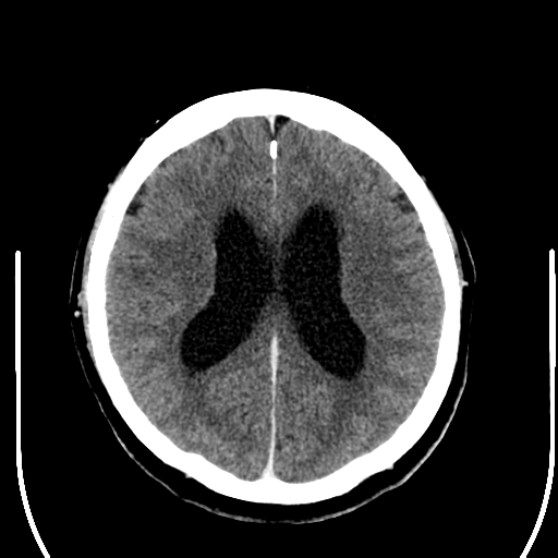 File:Acoustic schwannoma (Radiopaedia 39170-41389 Axial C+ 18).png