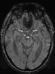 File:Acoustic schwannoma (Radiopaedia 55729-62281 Axial SWI 21).png