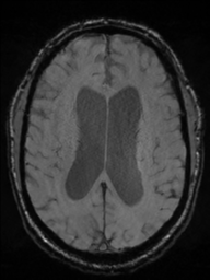 File:Acoustic schwannoma (Radiopaedia 55729-62281 Axial SWI 32).png