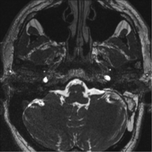 Acoustic schwannoma (translabyrinthine resection) (Radiopaedia 43570-46972 Axial CISS 17).png