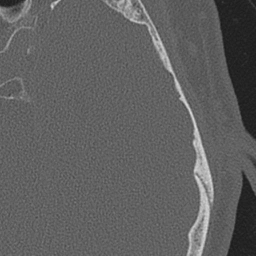 Acoustic schwannoma - cystic (Radiopaedia 29487-29980 AXIAL LEFT bone window 56).jpg