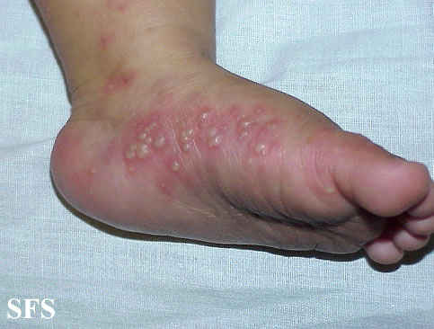Acropustulosis Infantile (Dermatology Atlas 3).jpg