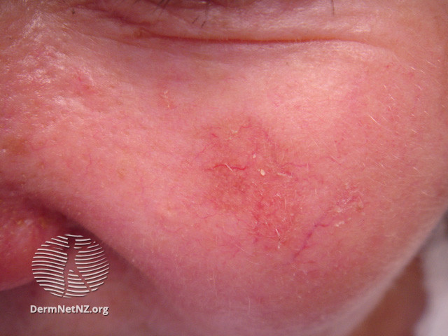 Actinic Keratoses affecting the face (DermNet NZ lesions-ak-face-305).jpg