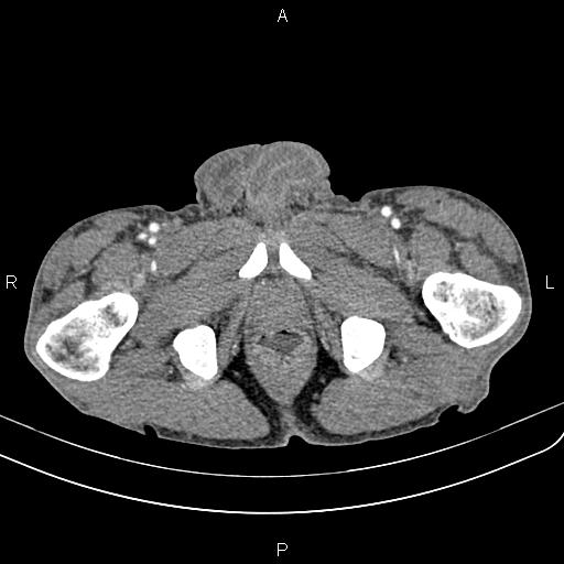 Active crohn disease (Radiopaedia 87133-103397 Axial C+ arterial phase 107).jpg