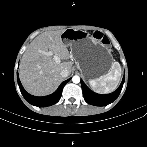 Active crohn disease (Radiopaedia 87133-103397 Axial C+ arterial phase 23).jpg