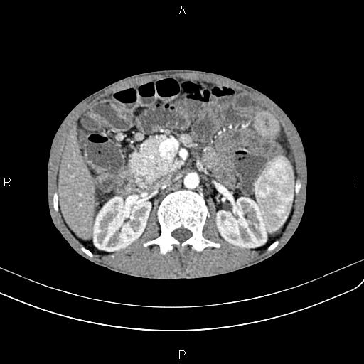 Active crohn disease (Radiopaedia 87133-103397 Axial C+ arterial phase 41).jpg