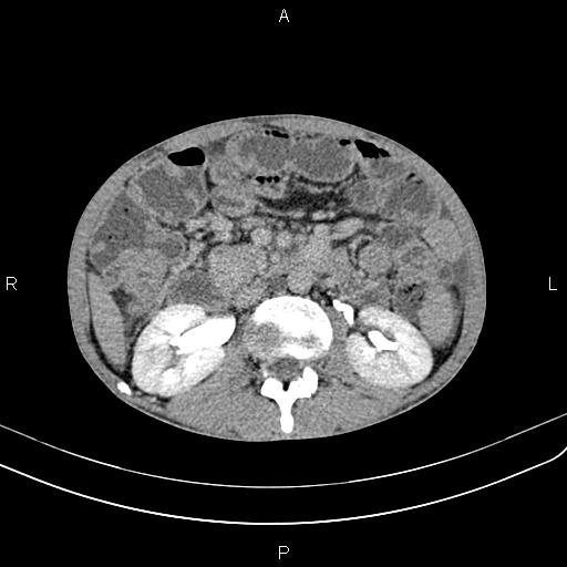 Active crohn disease (Radiopaedia 87133-103397 Axial C+ delayed 22).jpg