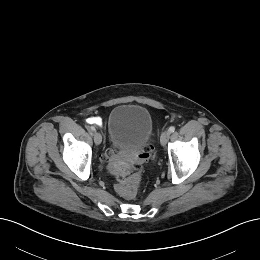File:Active lower gastrointestinal bleeding - diverticular (Radiopaedia 61203-69106 Axial C+ portal venous phase 111).jpg
