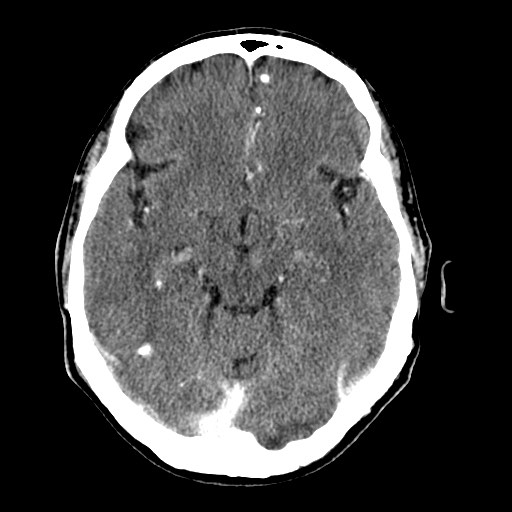 File:Active neurocysticercosis before and after therapy (Radiopaedia 71710-82099 Axial C+ delayed 63).jpg