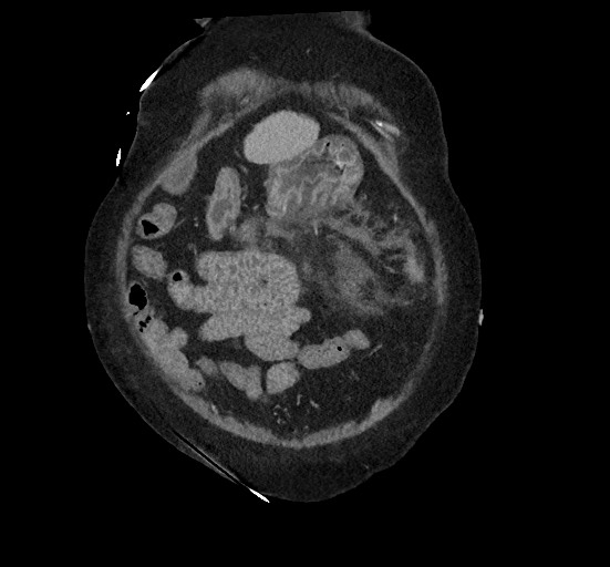 Active renal extravasation with large subcapsular and retroperitoneal hemorrhage (Radiopaedia 60975-68796 Coronal C+ portal venous phase 34).jpg