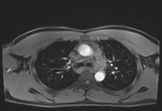Active right ventricular cardiac sarcoidosis (Radiopaedia 55596-62100 Axial Post contrast Dixon 19).jpg