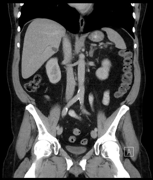 Acute-on-chronic pancreatitis (Radiopaedia 67286-76656 Coronal C+ portal venous phase 43).jpg