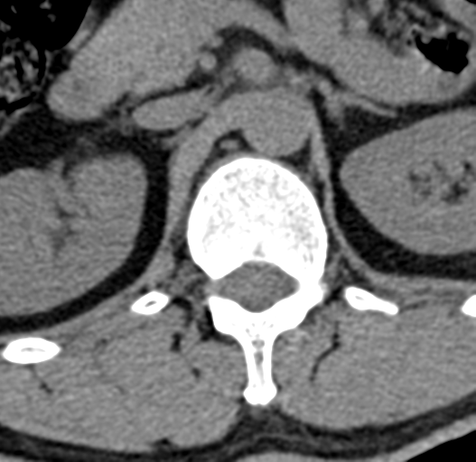 File:Acute L1 burst compression fracture (Radiopaedia 34430-35755 Axial non-contrast 14).png