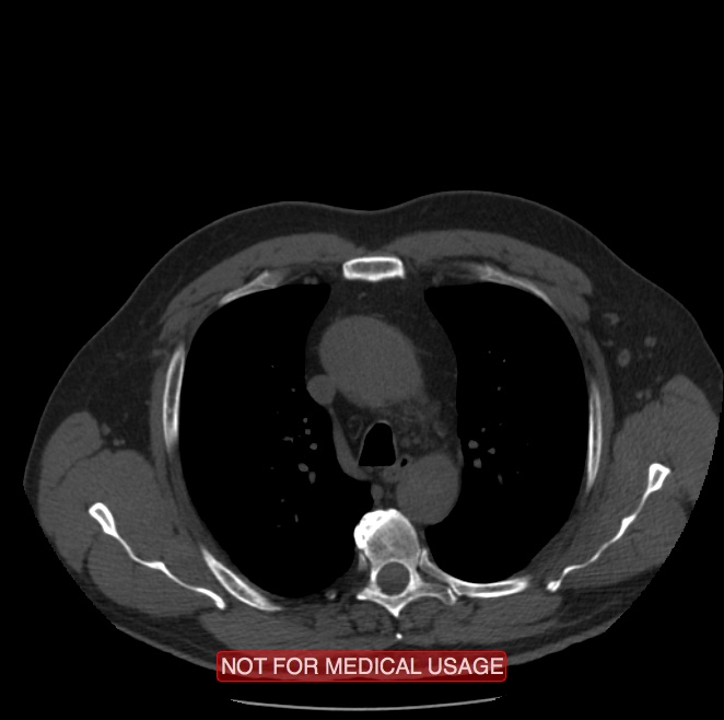 Acute aortic dissection - Stanford type A (Radiopaedia 40661-43285 Axial non-contrast 10).jpg