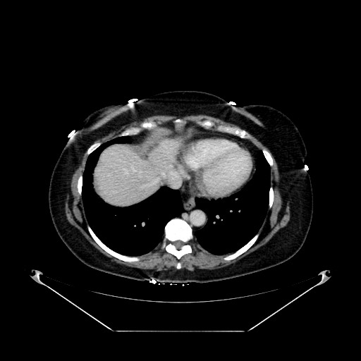 Acute appendicitis, heterotaxy syndrome (Radiopaedia 66884-76202 Axial C+ portal venous phase 14).jpg