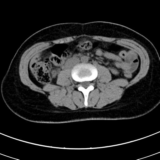 Acute appendicitis (Radiopaedia 30261-30888 Axial non-contrast 43).jpg