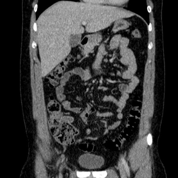 Acute appendicitis (Radiopaedia 38255-40270 Coronal C+ portal venous phase 32).jpg