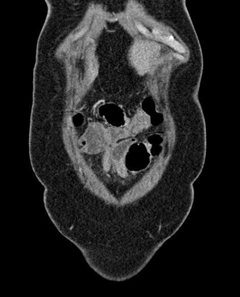 File:Acute appendicitis (Radiopaedia 48792-53822 Coronal C+ portal venous phase 36).jpg