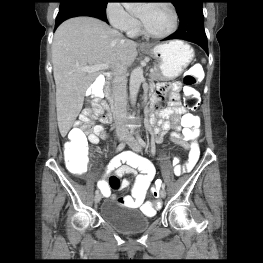 File:Acute appendicitis (Radiopaedia 52672-58589 Coronal C+ portal venous phase 47).jpg