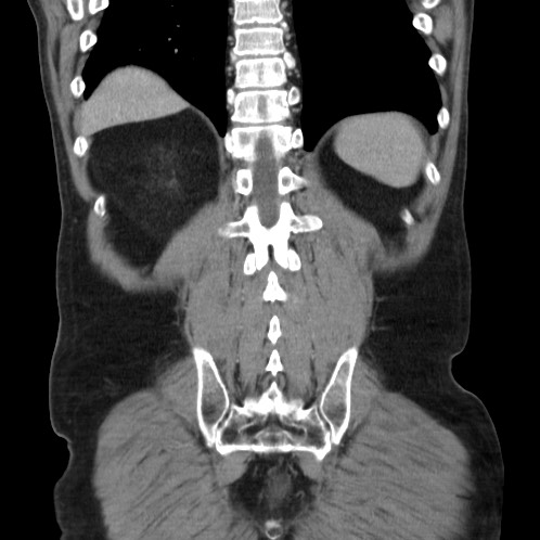 Acute appendicitis (Radiopaedia 66513-75790 Coronal C+ portal venous phase 75).jpg