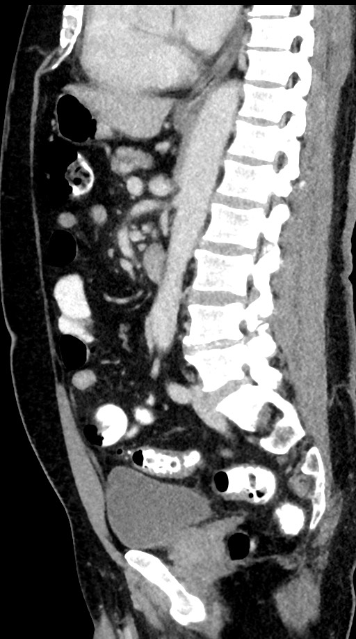 Acute appendicitis (Radiopaedia 77016-88960 Sagittal C+ portal venous phase 53).jpg