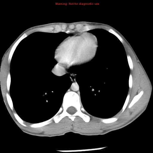 Acute appendicitis (Radiopaedia 8195-9045 Axial C+ portal venous phase 2).jpg