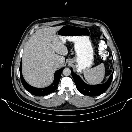 File:Acute appendicitis (Radiopaedia 84780-100240 Axial C+ portal venous phase 20).jpg