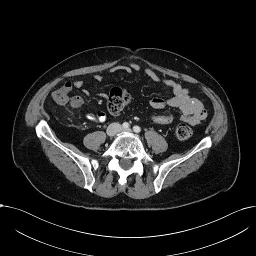 Acute appendicitis - large appendicoliths (Radiopaedia 61805-69820 Axial C+ portal venous phase 83).jpg