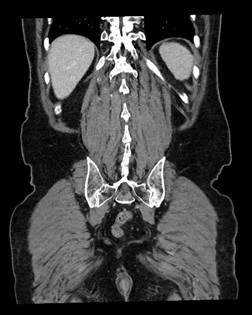 Acute appendicitis - large appendicoliths (Radiopaedia 61805-69820 Coronal C+ portal venous phase 111).jpg