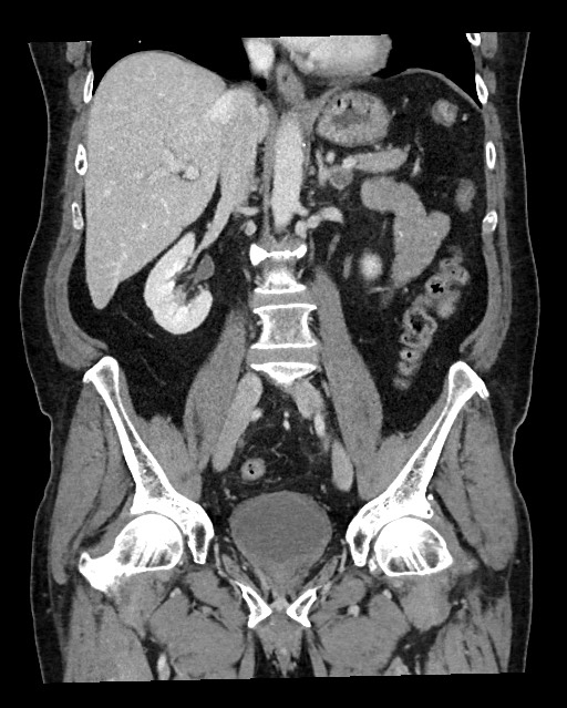 Acute appendicitis - large appendicoliths (Radiopaedia 61805-69820 Coronal C+ portal venous phase 73).jpg