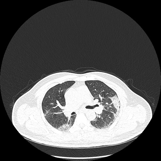 File:Acute appendicitis and COVID 19 pneumonia (Radiopaedia 76604-88380 Axial lung window 24).jpg