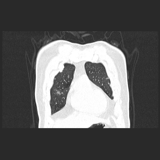 Acute appendicitis and COVID 19 pneumonia (Radiopaedia 76604-88380 G 13).jpg