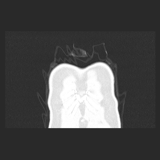 File:Acute appendicitis and COVID 19 pneumonia (Radiopaedia 76604-88380 G 4).jpg
