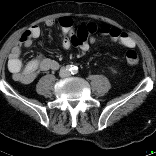 File:Acute appendicitis arising from a malrotated cecum (Radiopaedia 19970-19997 Axial C+ portal venous phase 24).jpg