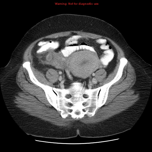 File:Acute appendicitis complicated by ovarian vein thrombophlebitis (Radiopaedia 16172-15851 Axial C+ portal venous phase 71).jpg